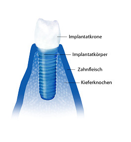 Implantation