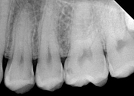 Zahn Röntgen